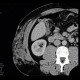 Angiolipoma, subcutaneous, selective embolisation: CT - Computed tomography
